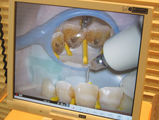 藤沢の歯医者で根管治療