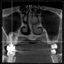 藤沢の歯医者で根管治療