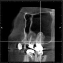 藤沢の歯医者で根管治療