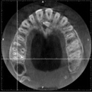 藤沢の歯医者で根管治療