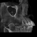 藤沢の歯医者で根管治療