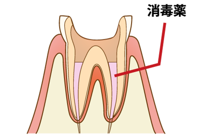 藤沢の歯医者で根管治療