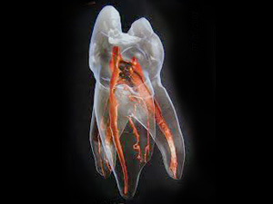 藤沢の歯医者で根管治療