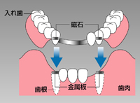 藤沢市の歯医者で入れ歯治療